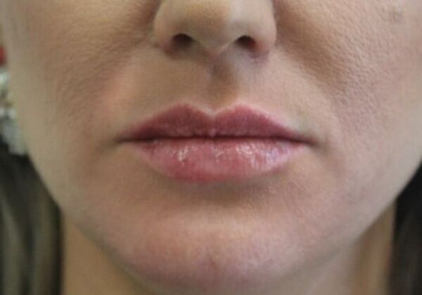 Injectables Case 55 - After