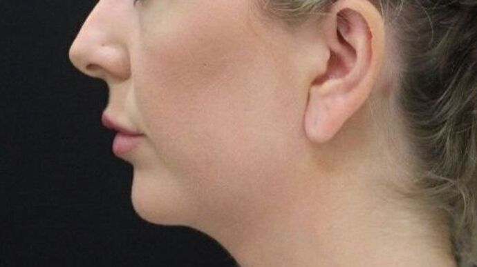 Injectables Case 56 - After