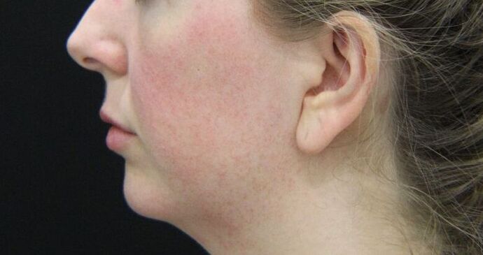 Injectables Case 56 - Before