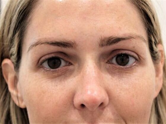 Injectables Case 57 - Before