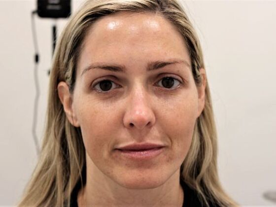 Injectables: Case 57 - Before