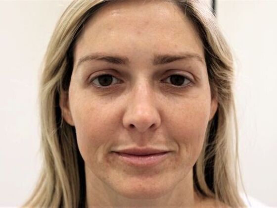 Injectables: Case 57 - After