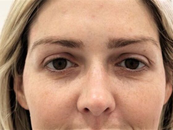 Injectables Case 57 - After