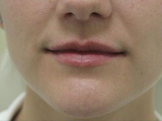 Injectables Case 58 - Before