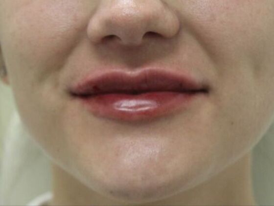 Injectables Case 58 - After