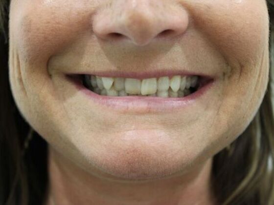 Injectables: Case 59 - Before