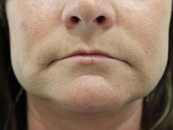 Injectables Case 59 - Before