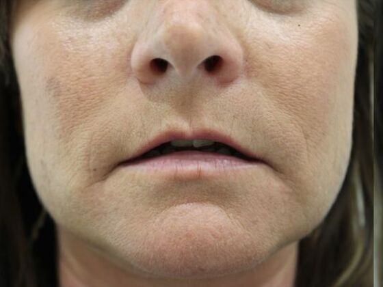 Injectables: Case 59 - Before