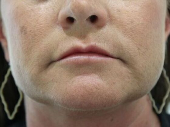 Injectables Case 59 - After