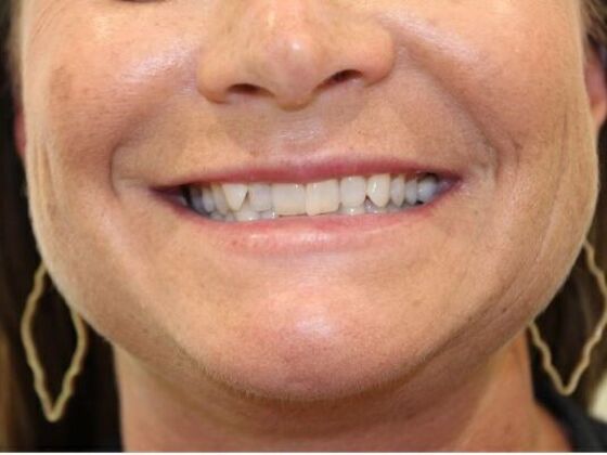 Injectables: Case 59 - After