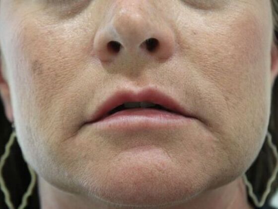 Injectables: Case 59 - After