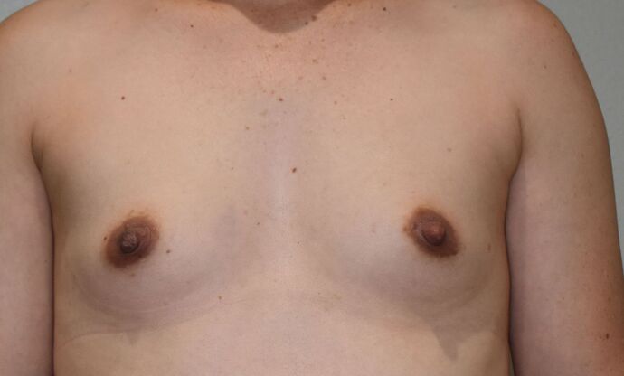 Breast Augmentation Case 729 - Before