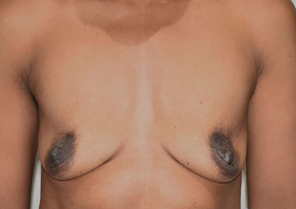 Breast Augmentation Case 730 - Before