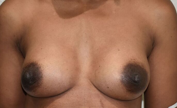 Breast Augmentation Case 730 - After