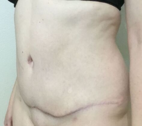 Morpheus 8 Case 1 - After