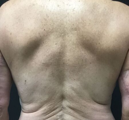 Morpheus 8 Case 2 - After