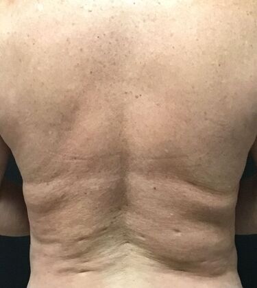 Morpheus 8 Case 3 - Before