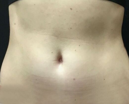 Morpheus 8 Case 4 - Before