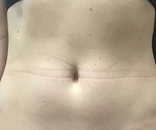 Morpheus 8 Case 4 - After