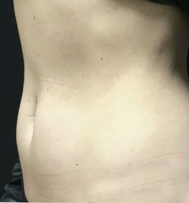 Morpheus 8: Case 4 - Before