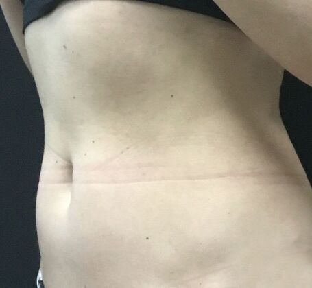 Morpheus 8: Case 4 - After