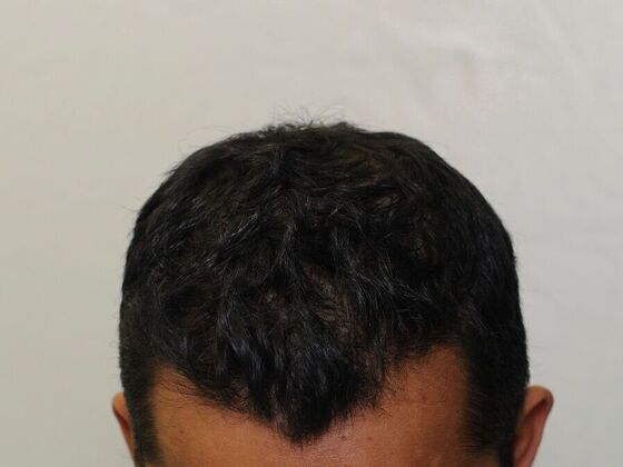 FUT Hair Restoration: Case 23 - After