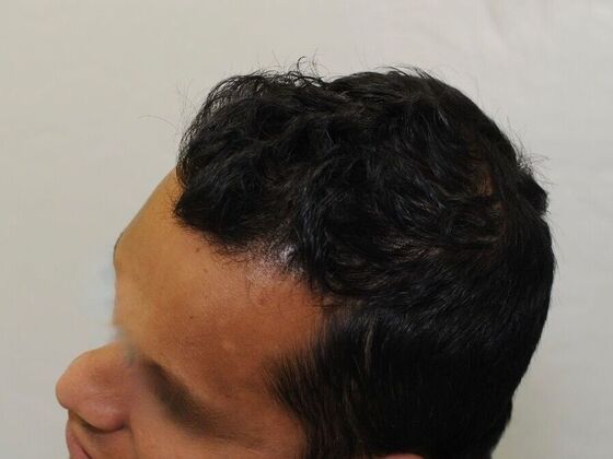 FUT Hair Restoration: Case 23 - After