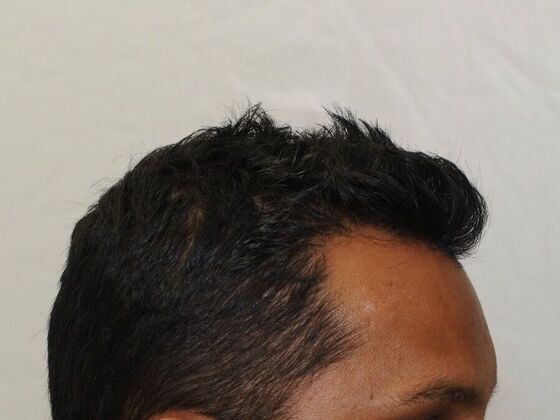 FUT Hair Restoration: Case 23 - After