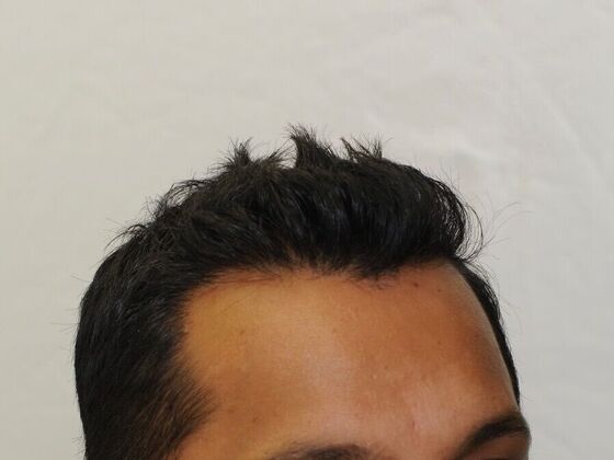 FUT Hair Restoration: Case 23 - Before
