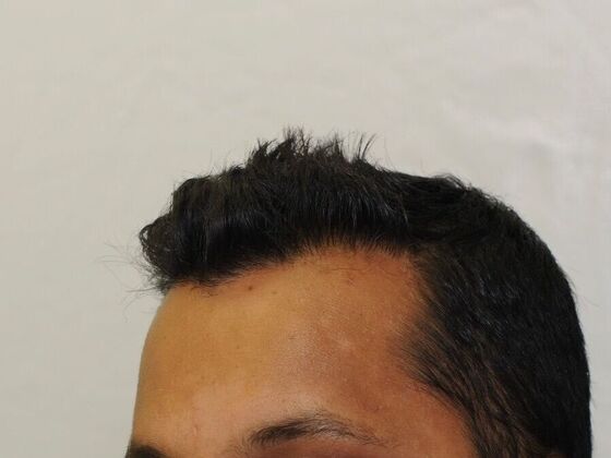 FUT Hair Restoration: Case 23 - After