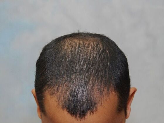 FUT Hair Restoration: Case 23 - Before