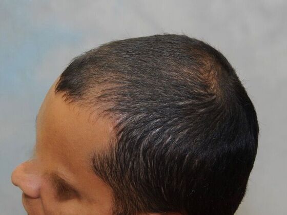 FUT Hair Restoration: Case 23 - Before
