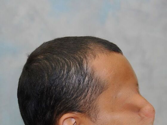 FUT Hair Restoration: Case 23 - Before