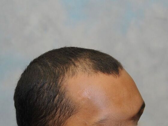 FUT Hair Restoration: Case 23 - After