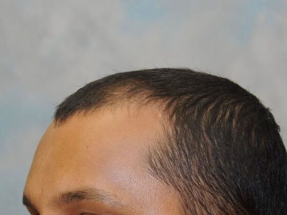 FUT Hair Restoration: Case 23 - Before