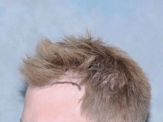 FUT Hair Restoration: Case 24 - Before