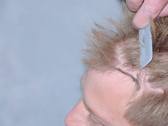 FUT Hair Restoration: Case 24 - After