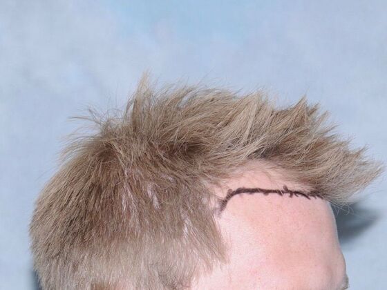 FUT Hair Restoration: Case 24 - Before