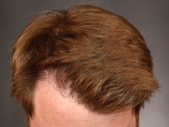 FUT Hair Restoration: Case 24 - After