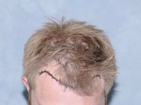 FUT Hair Restoration: Case 24 - Before