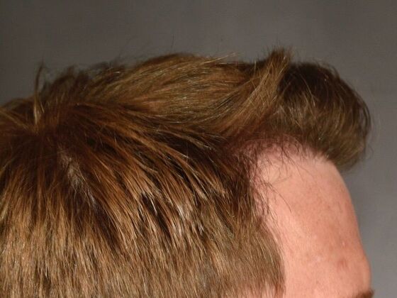 FUT Hair Restoration: Case 24 - After