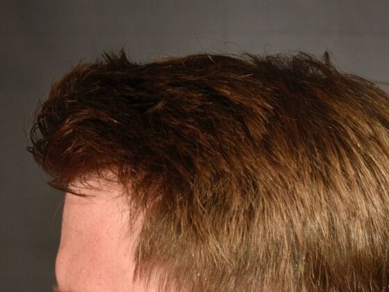 FUT Hair Restoration: Case 24 - Before