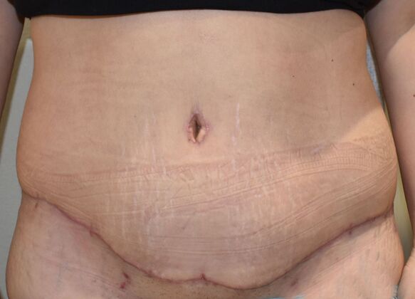Tummy Tuck (Abdominoplasty): Case 409 - After
