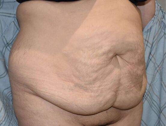 Tummy Tuck (Abdominoplasty): Case 409 - Before