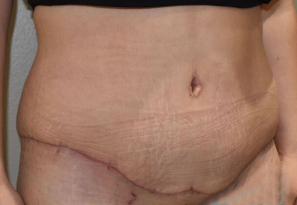 Massive Weight Loss : Case 128 - After