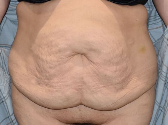 Massive Weight Loss : Case 128 - Before