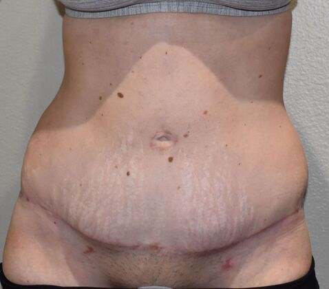 Massive Weight Loss : Case 113 - After