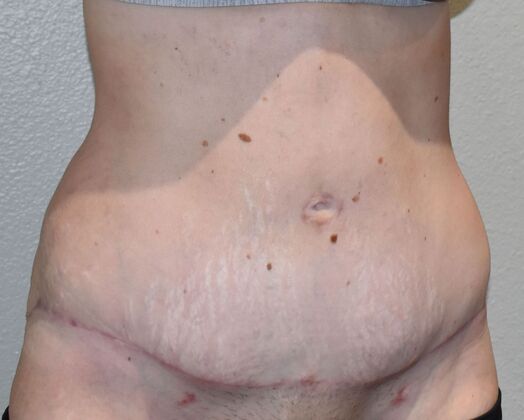 Massive Weight Loss : Case 113 - After