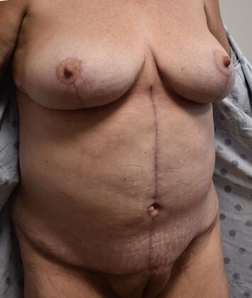 Mommy Makeover: Case 266 - After