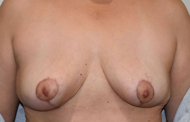 Breast Implant Removal: Case 26 - After